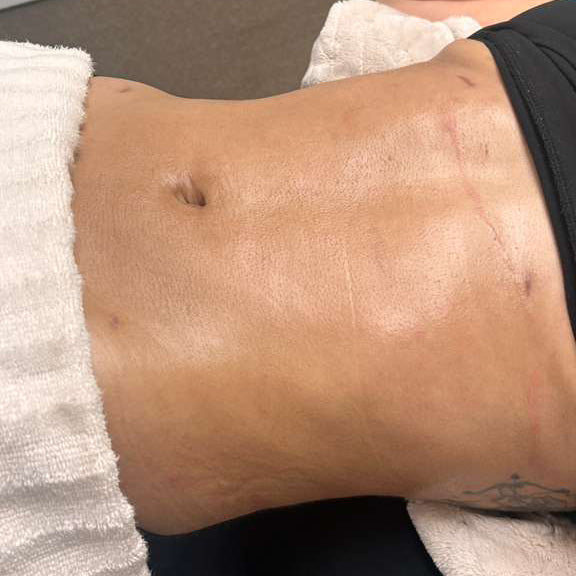 Corrección de Fibrosis