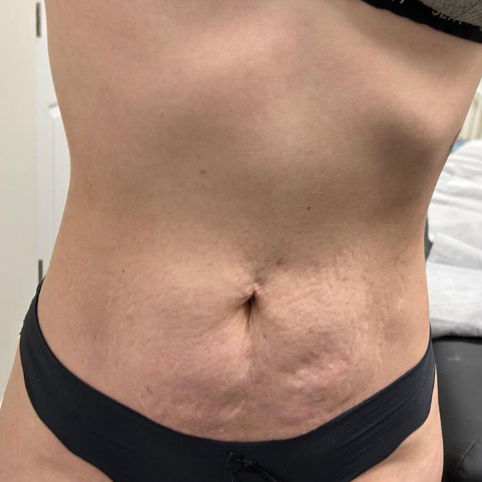 Corrección de Fibrosis