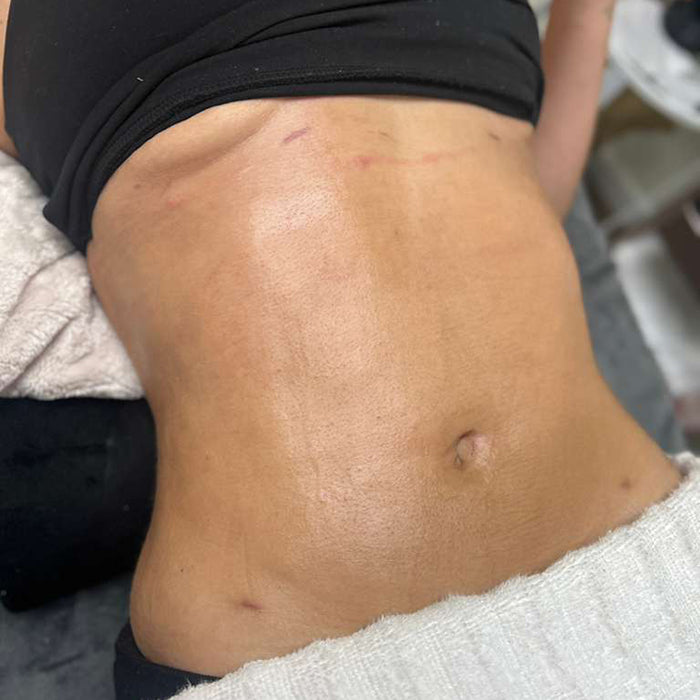 Corrección de Fibrosis